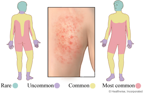 Will you have Skin rash with Biotin? - eHealthMe